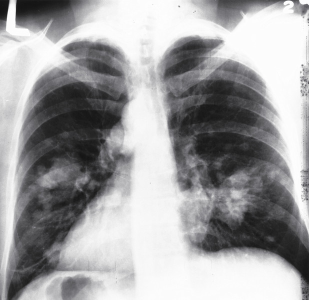 英國研究指出,抑癌基因「BRCA2」突變者若吸菸,罹患肺癌的機率為常人的1.8倍。(photo by維基百科)