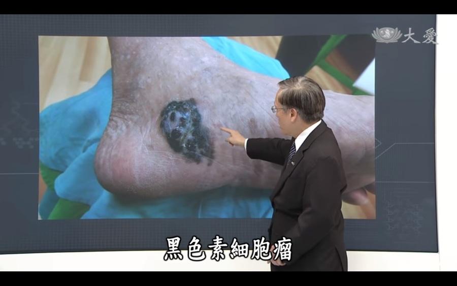 致死率居皮膚癌之冠的黑色素瘤3、4期患者,因癌症免疫療法「抗PD-1抗體」治療而出現一線生機。(Photo by影片截圖)